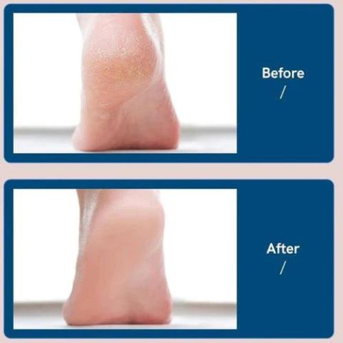 Elektrische Pediküre-Feile